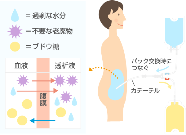 腹膜透析